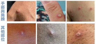 台中今年首例M痘本土病例 男子曾無套性行為