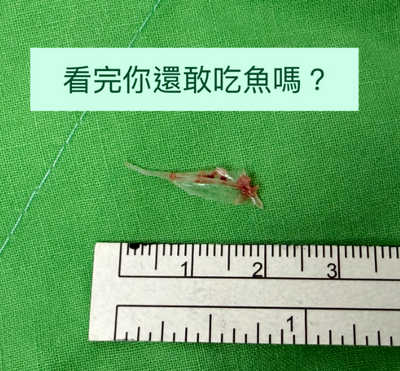 健康網》6旬婦2公分長魚刺卡食道  醫籲救命別做「這事」