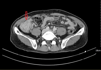 義大癌醫院癌症腹膜轉移治療成果 登國際期刊