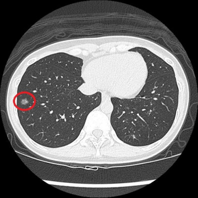 早期肺癌難察覺  國健署補助老菸槍2年1次公費LDCT揪出病灶