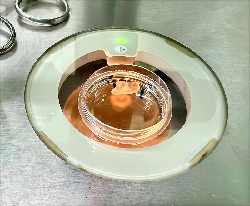 留下生育希望 罹癌女術前保存卵巢組織