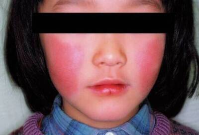 健康網》一聲尖叫後昏迷！ 11歲女童疑染「蘋果病」併發猛爆性心肌炎不治