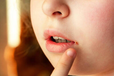 健康網》嘴角破、腳跟裂、脖子變黑？  百萬網紅醫：多半不是缺營養