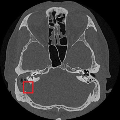慢性中耳炎勿輕忽  併發膽脂瘤造成聽力與神經損傷