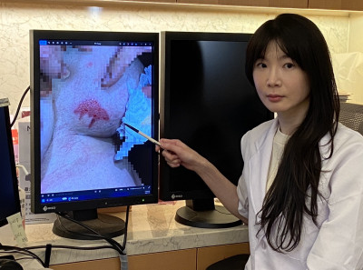 暖暖包放乳溝9小時 55歲婦慘遭二級燙傷