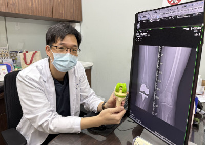 8旬嬤X型腿慘跌骨折 置換人工膝關節讓不再卡卡