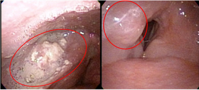 喉嚨痛、吞嚥卡卡注意！55歲男3期下咽癌 免疫治療搭配手術相助
