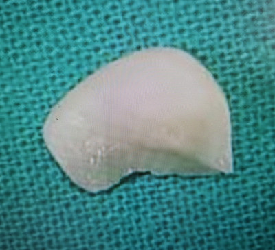 驚！女遭馬爾濟斯狠咬右眼 狗牙還卡在眼裡