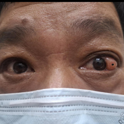 獨家》驚！6旬男竟冒出第3隻眼 醫揭長瘤又冒黑痣相當罕見