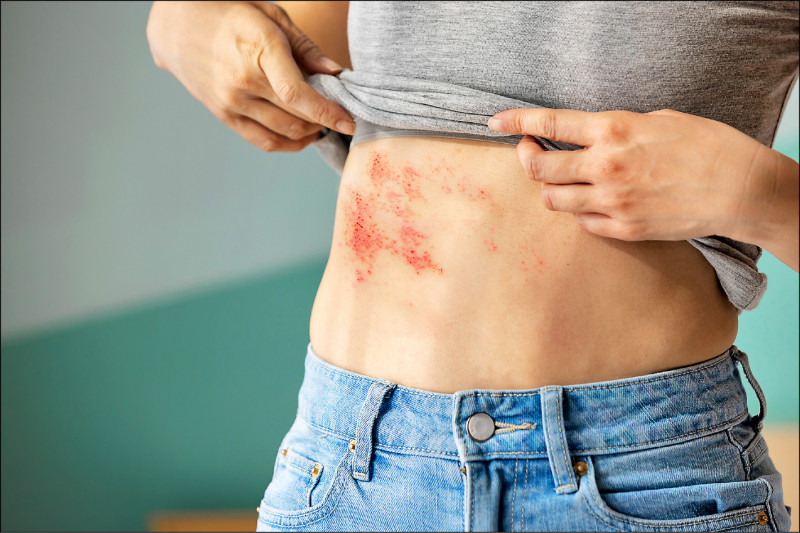 不只皮膚問題 皮蛇恐釀長期神經痛