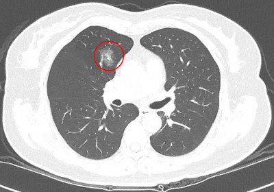 台北慈濟醫院研究：LDCT篩出結節過半為惡性