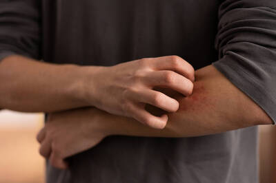 健康網》換季悶熱濕疹癢到受不了！ 營養師點名4類食物先別碰