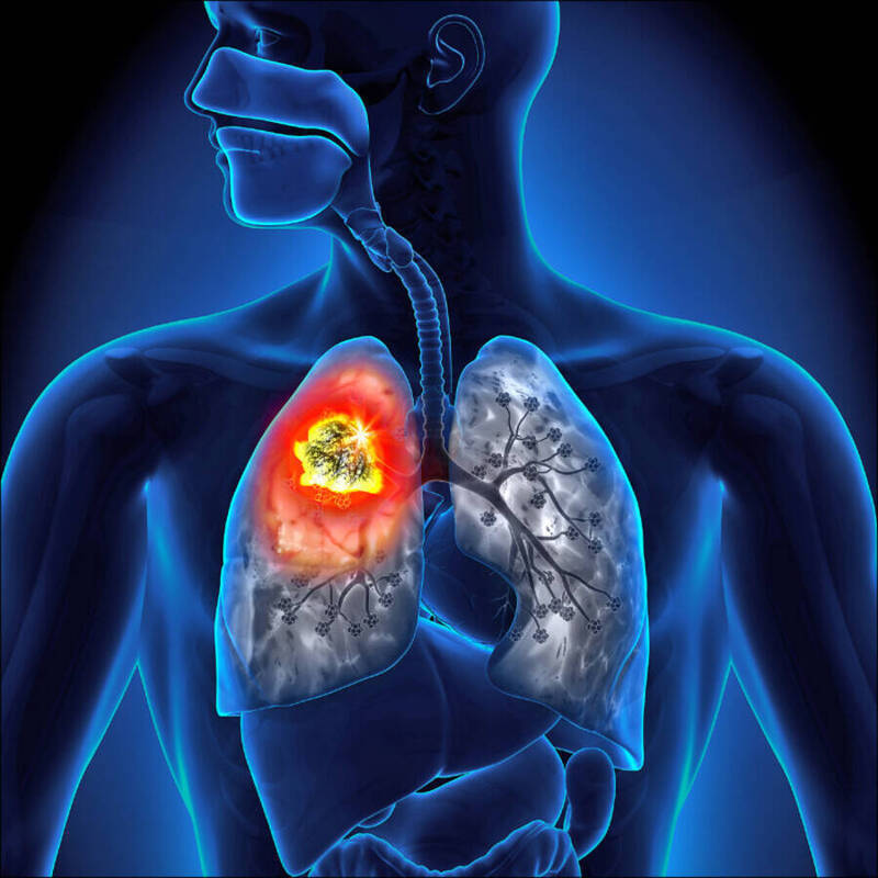 不吸菸年輕人肺癌增！ 研究：高蔬果攝取者確診率偏高但原因未明