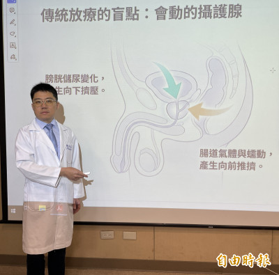 近40次放療變5次  醫揭攝護腺癌治療新趨勢