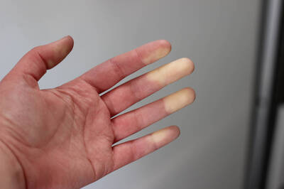 健康網》手上西米露？醫：「汗皰疹」壓力大也會發生