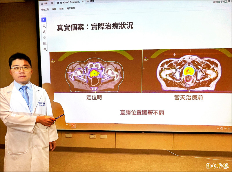 2週5次! 磁振刀縮短攝護腺癌療程
