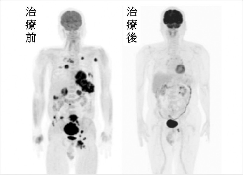 黑色素癌患者存活10年見證療效 台癌籲免疫藥物納第一線給付