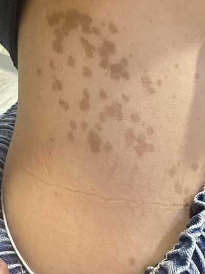 健康網》近3成兒童有「咖啡牛奶斑」醫：須關注有無擴大