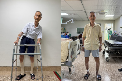 82歲印尼華僑身體嚴重傾斜到嘉義求醫 微創脊椎手術助重拾挺直人生