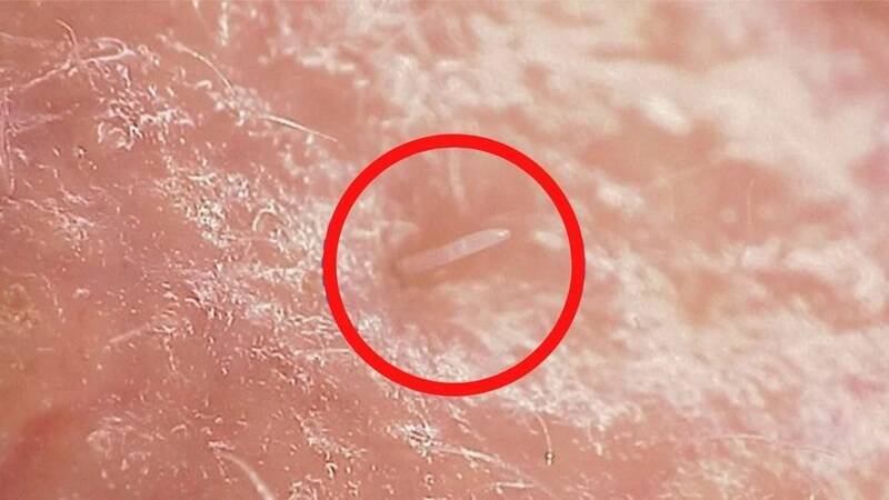 每個人臉上都有 研究揭毛孔蟎蟲正從寄生變共生