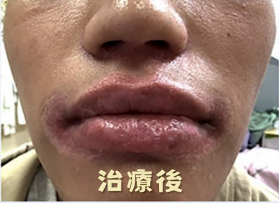嘴唇潰爛發黑、黴菌吃進內臟 17歲少年靠半吻合造血幹細胞移植奇蹟重生