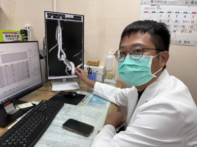 婦人雷擊性頭痛竟是腦動脈瘤破裂 南投醫院經動脈栓塞術搶命