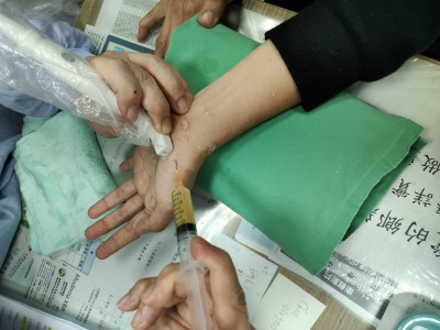「腕隧道症候群」術後疤卡住 痛到睡不著！打PRP一覺到天亮
