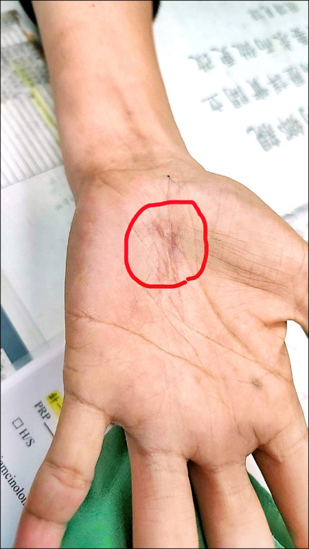 腕隧道症候群術後沾黏 PRP減痛換好眠