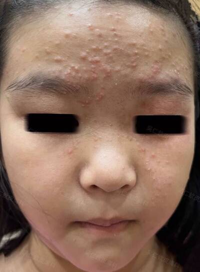 健康網》7歲女童滿臉爆痘花 媽媽崩潰急問性早熟 醫揪3元凶