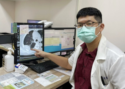 久咳不癒卻精神好到能上班 CT驚見肺部「白月樹影」
