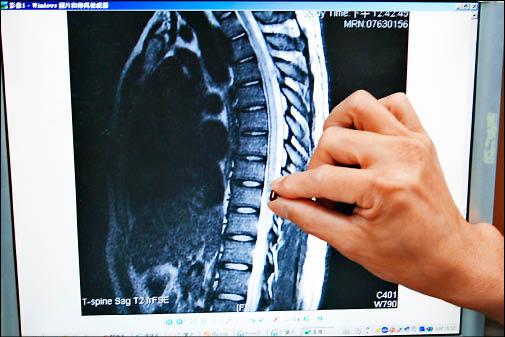 脊髓內血管瘤按摩破裂 28歲男險癱