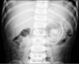 輸尿管病變 又三餐加鈣 幼兒腎結石