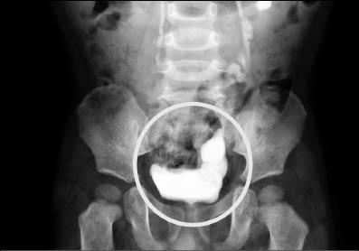 輸尿管病變 又三餐加鈣 幼兒腎結石