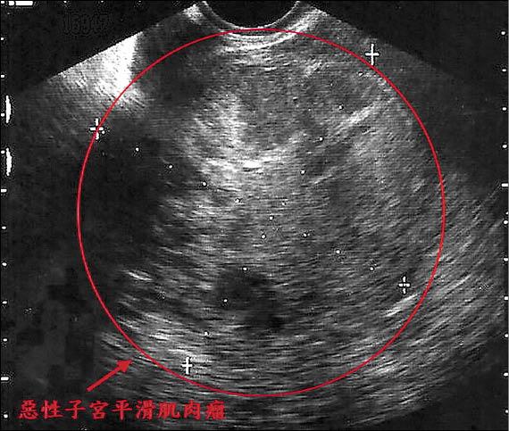 子宮肌腺瘤變大 當心是惡性