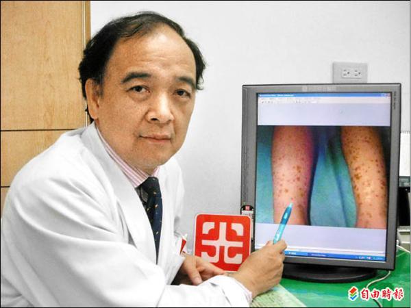 紫斑症作怪 婦血小板低下險丟命