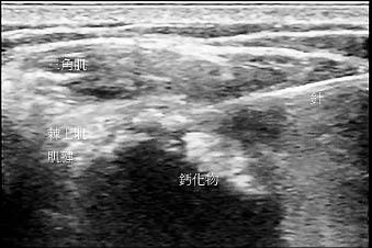 鈣化性肌腱炎 手一抬舉就痠痛