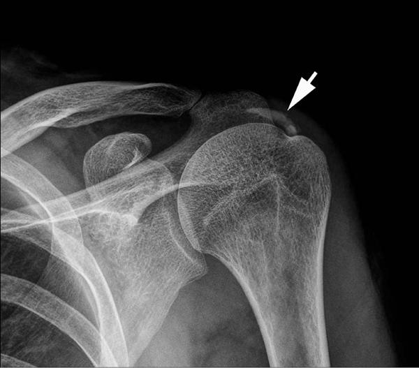 鈣化性肌腱炎 手一抬舉就痠痛