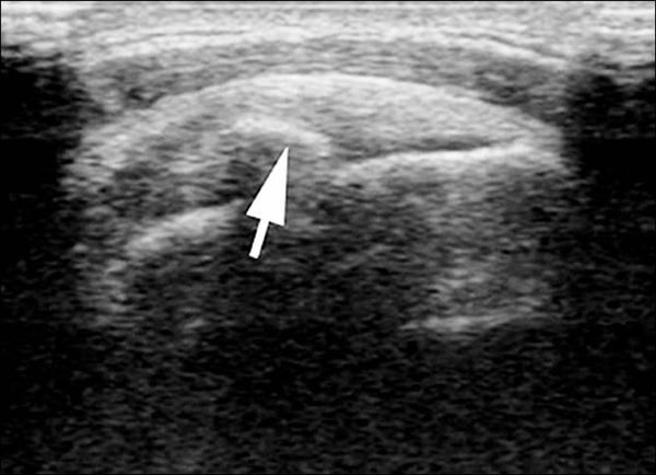 鈣化性肌腱炎 手一抬舉就痠痛