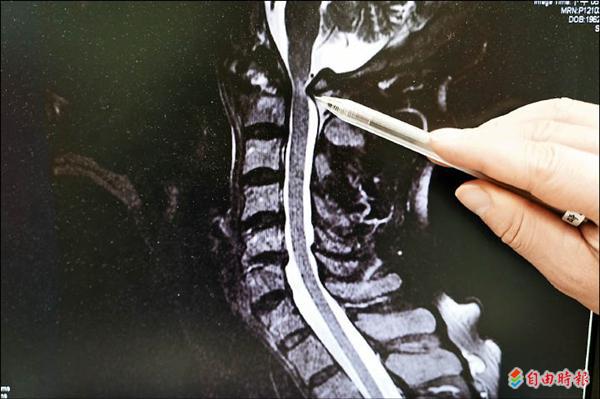 跌倒沒外傷… 一年後竟癱瘓