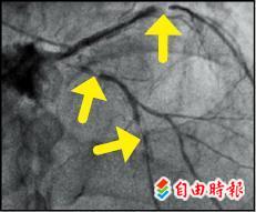 血管反覆阻塞 繞道手術救命