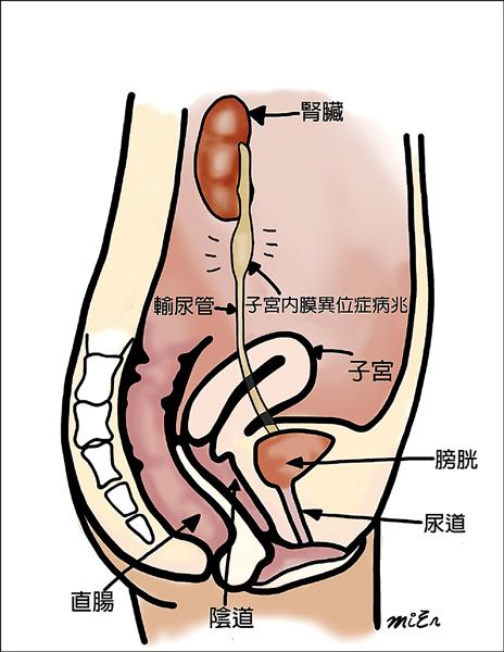 月經期間頻尿、急尿 恐膀胱的子宮內膜異位症