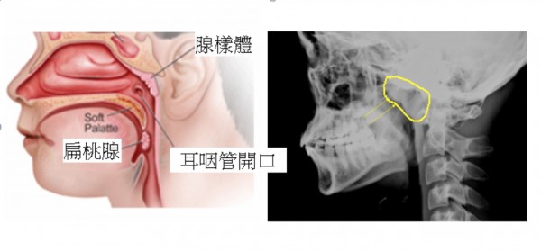 國中生反覆鼻竇炎 腺樣體增生大如乒乓球塞鼻腔
