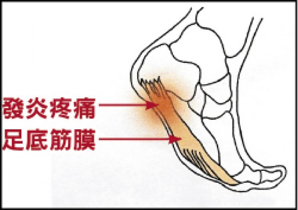 路跑隔天腳底痛 小心足底筋膜炎