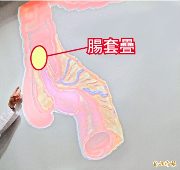 大腸包小腸 男大生「腸套疊」腹痛就醫