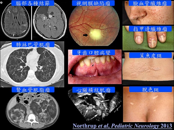 結節性硬化症による腫瘍