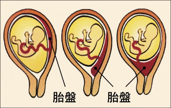 前置胎盤の治療