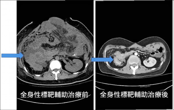 29歲罹腎細胞癌 全身性標靶治療續命 自由健康網