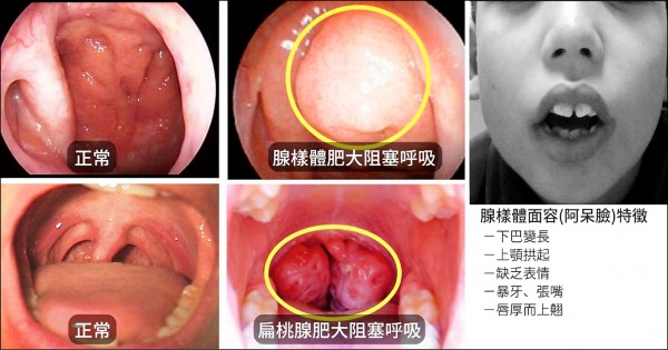 睡覺打鼾嘴開開當心小朋友臉長歪- 自由健康網