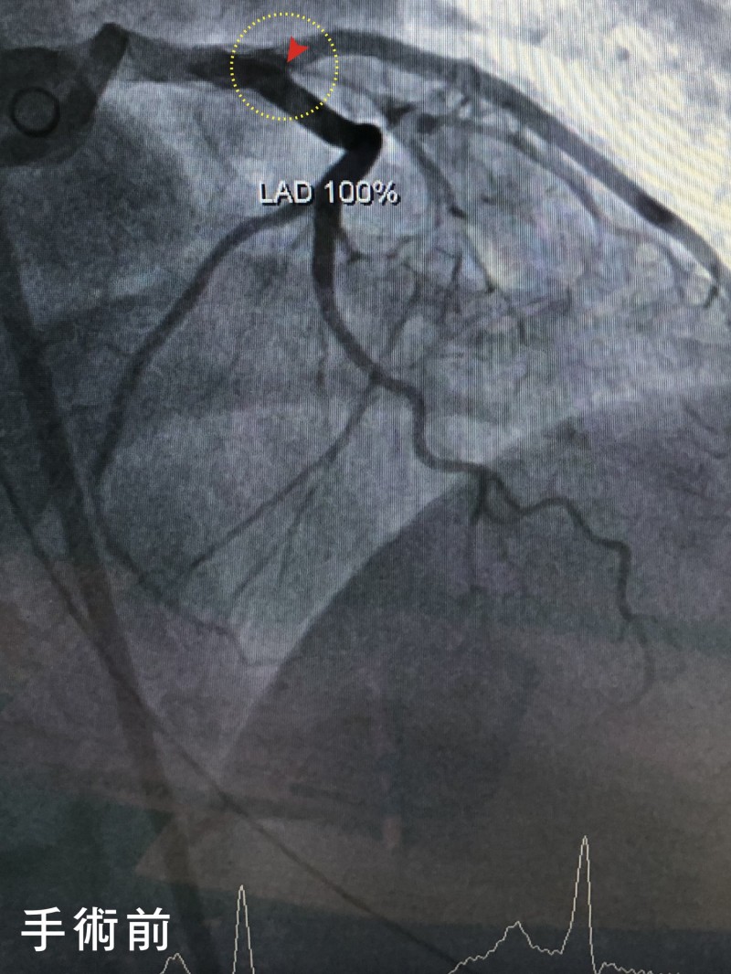 誤把胸悶痛當胃病 34歲新婚婦急性心肌梗塞險喪命