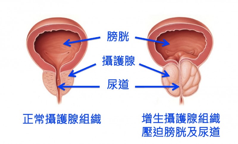 經尿道前列腺切除術（Transurethral resection of the prostate, TURP）是治療攝護腺肥大的標準處理方法